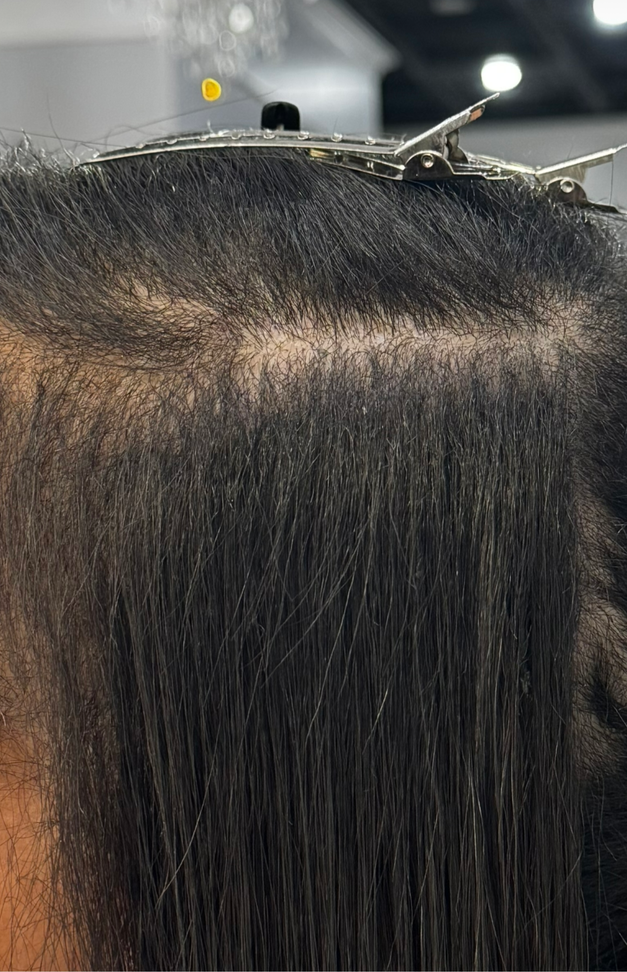 Fusion Invisible K-Tip Extension Service