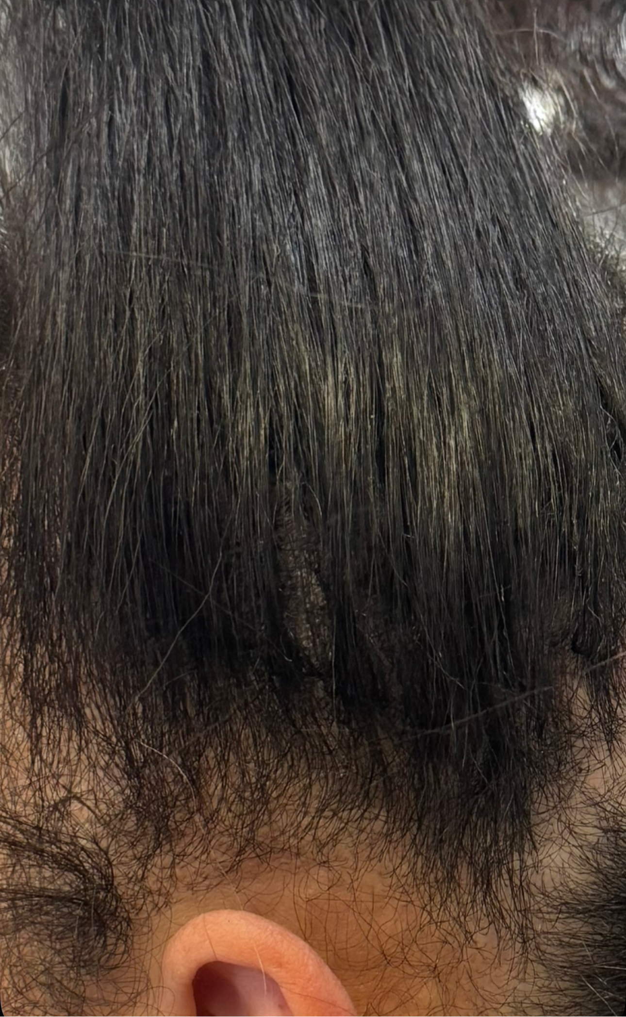 Fusion Invisible K-Tip Extension Service